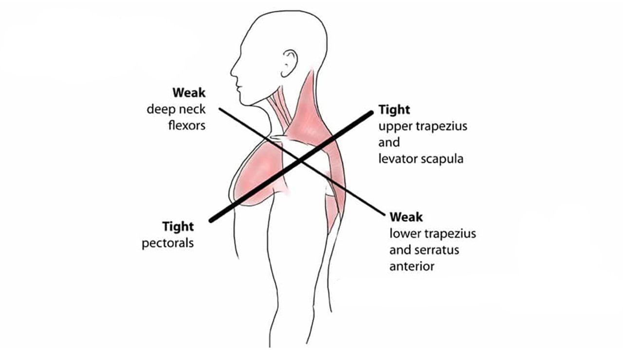 upper-crossed-syndrome-1080x600-1
