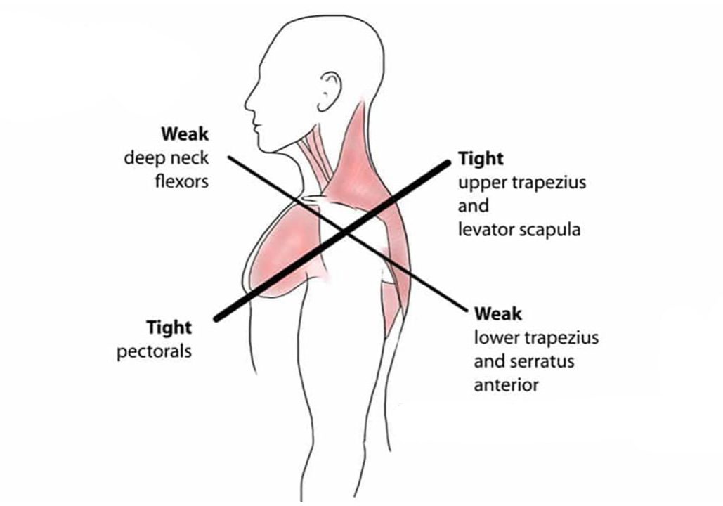 upper-crossed-syndrome-1080x600-1 upper-crossed-syndrome-1080x600-1